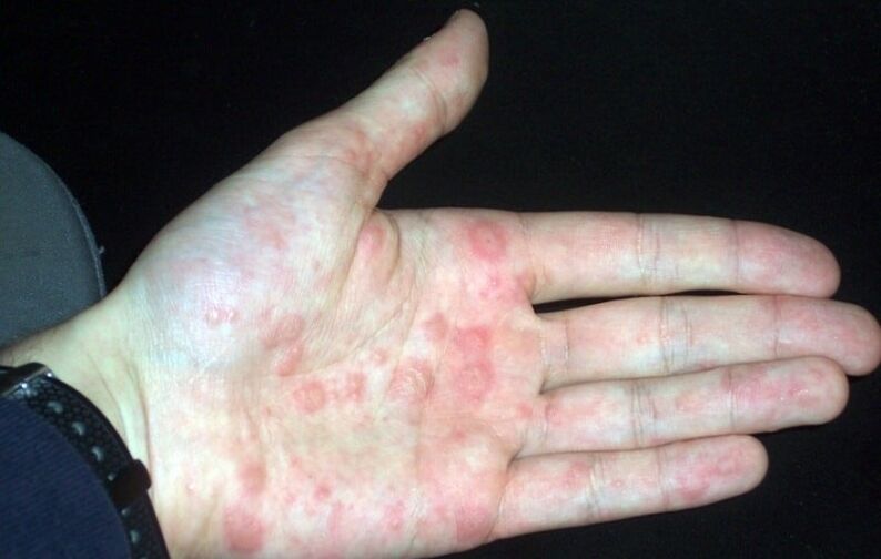 plaque psoriasis on hands