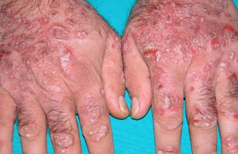tear psoriasis on hands