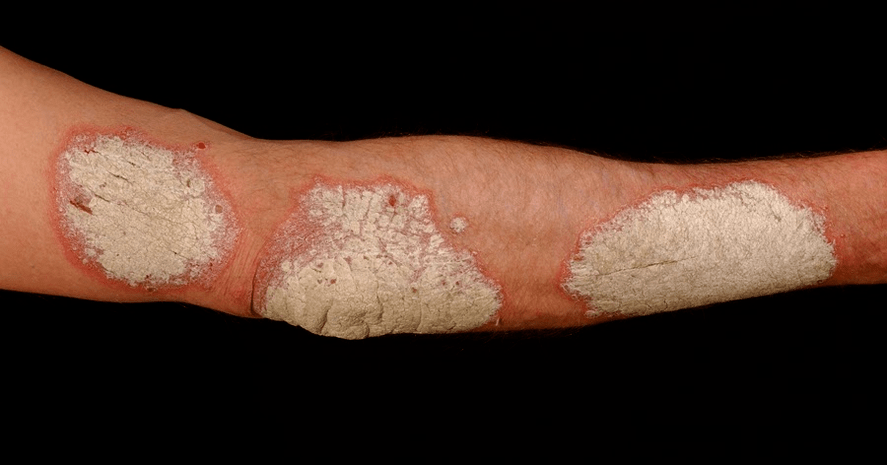 exudative psoriasis in the body