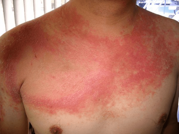 irritated psoriasis in the body