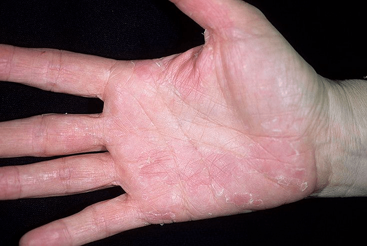 psoriasis of the palms and below