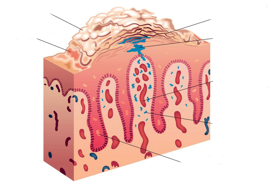 skin cross section in psoriasis
