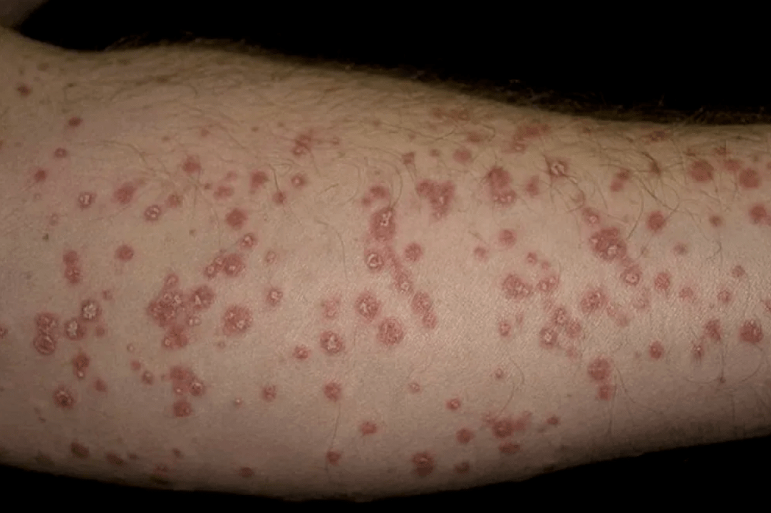 spotted psoriasis