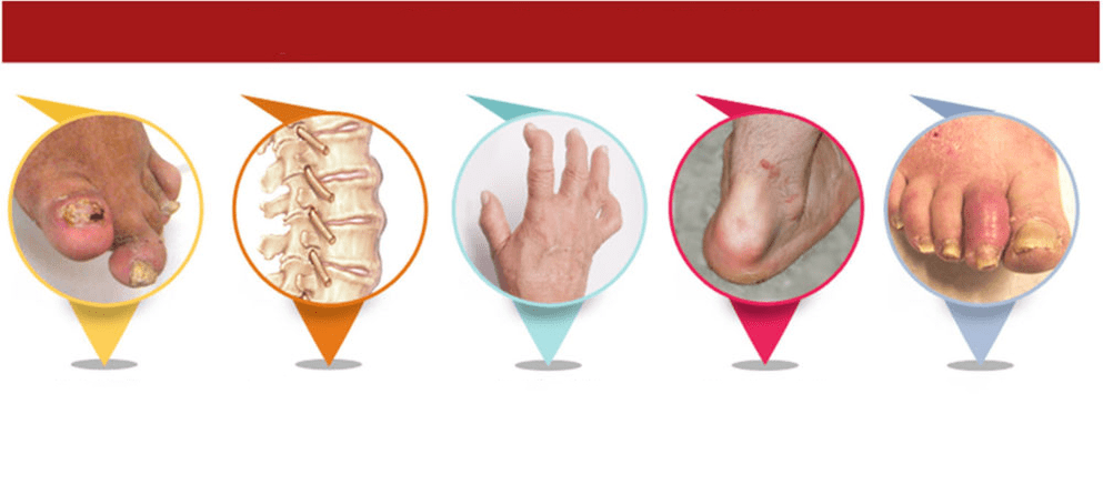 types of psoriatic arthritis