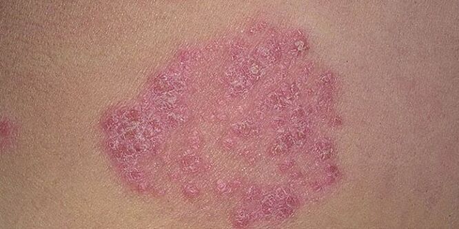 papule on the skin of the legs with psoriasis