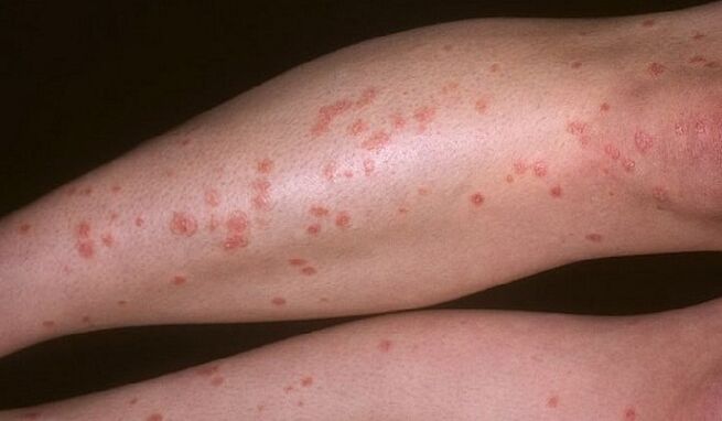 tear psoriasis in the legs