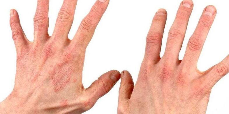 hand psoriasis how to treat folk remedies