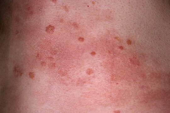 progressive stage of the course of psoriasis