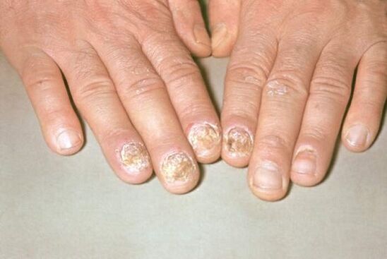 psoriasis nails photo 1