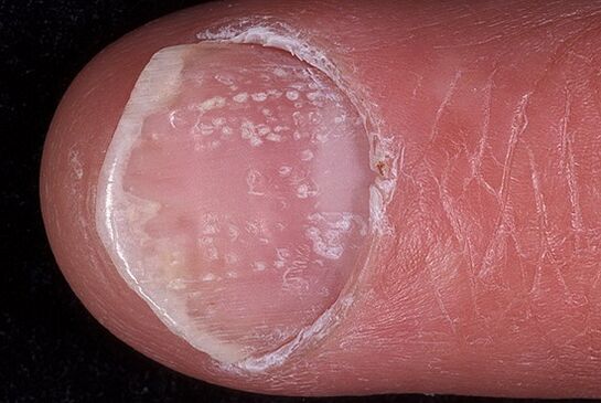 psoriasis nails photo 2
