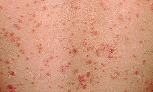 how does psoriasis initial stage