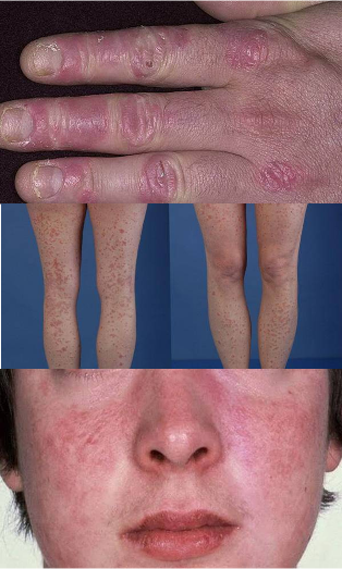 how does psoriasis on the hands, feet and face