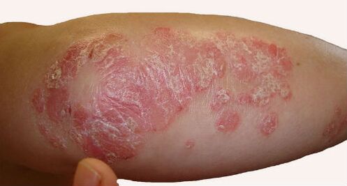 Bulky, scaly plaques on the elbow during psoriasis exacerbation