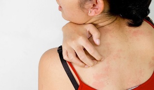Psoriasis on the back