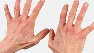 how is the initial stage of psoriasis