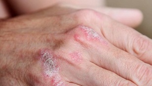 symptoms of early psoriasis