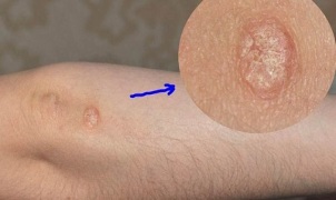 developmental stages of psoriasis