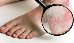 psoriasis therapy options