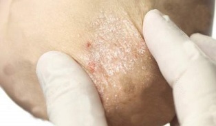 treatment of psoriasis in the attenuation phase