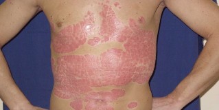 instructions for the treatment of psoriasis