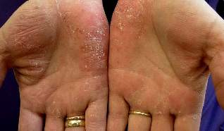 medications from psoriasis