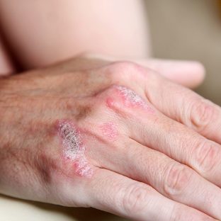 the manifestations of psoriasis