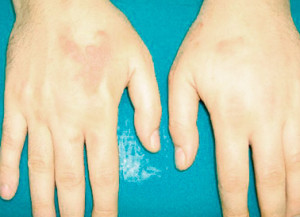 Localization of the disease on the hands