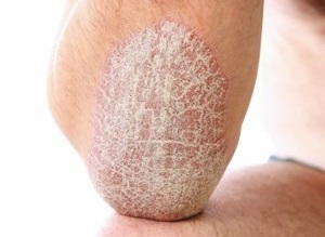 the main manifestations of psoriasis