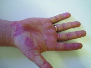 Pustules of the palms and soles