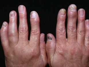arthritis psoriasis